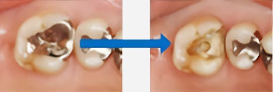 現在の歯の状況・歯周環境の確認