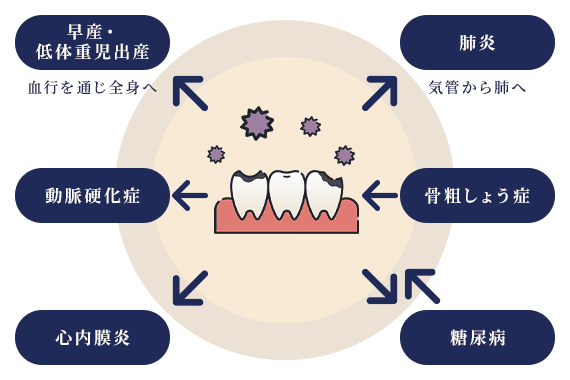 歯周病から様々な病気へ